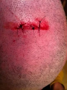 Suturing a scalp