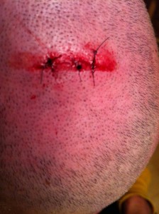 Suturing a scalp